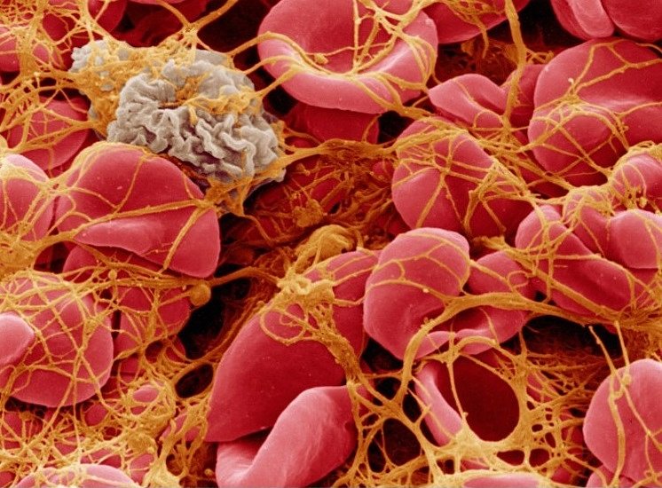 blood clot