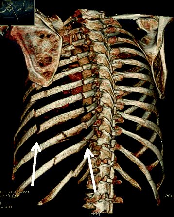rib fracture