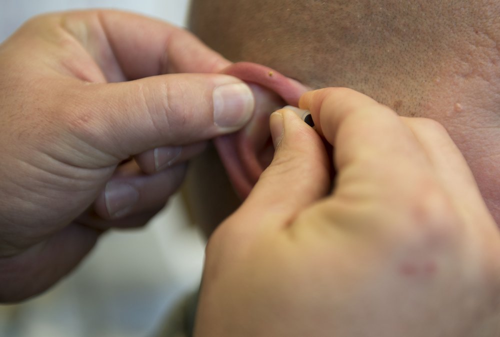 acupuncture