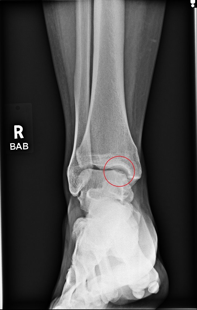 Xray