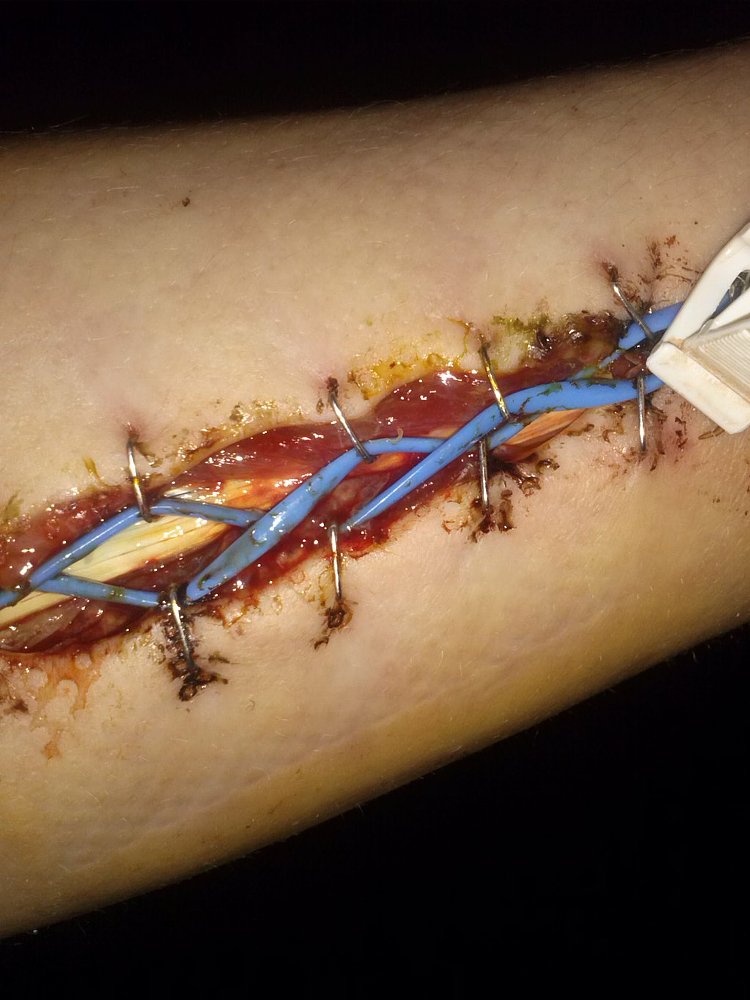 fasciotomy
